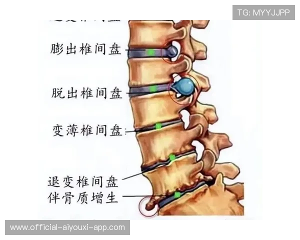 椎间盘突出的瑜伽治愈：手术台的最后一刻，瑜伽治疗腰椎间盘突出的康复视频